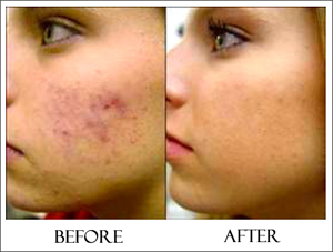 micro-before-after