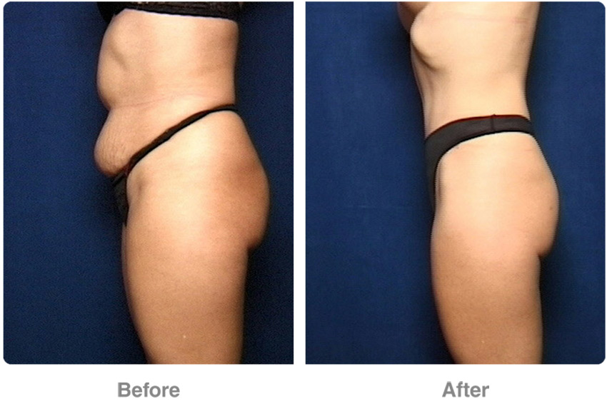 before-after